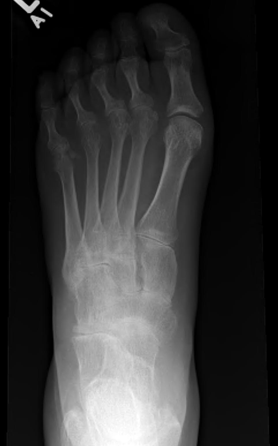 Rheumatoid Foot AP